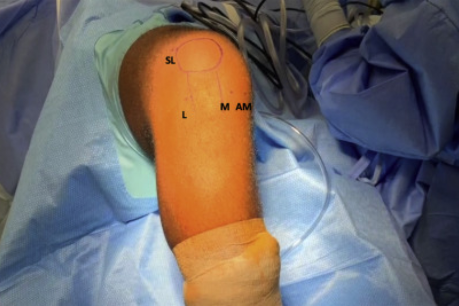 Anterior Cruciate Ligament Repair