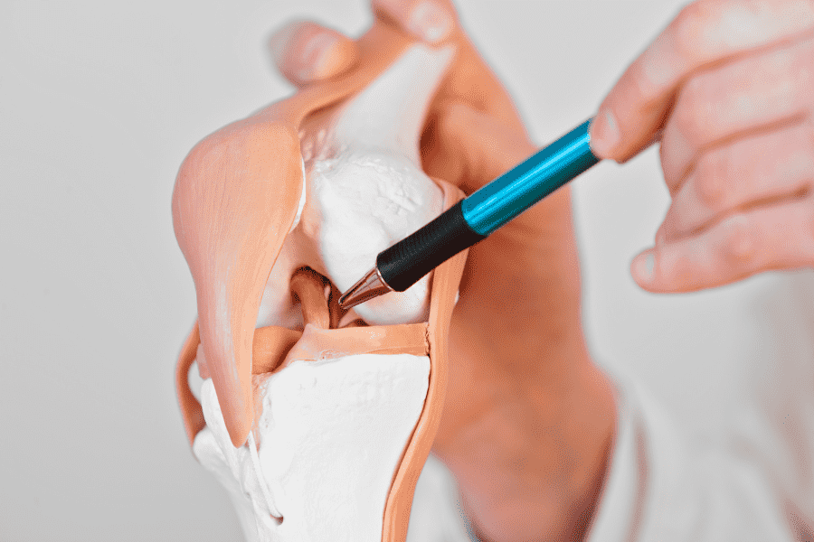 acl reconstruction