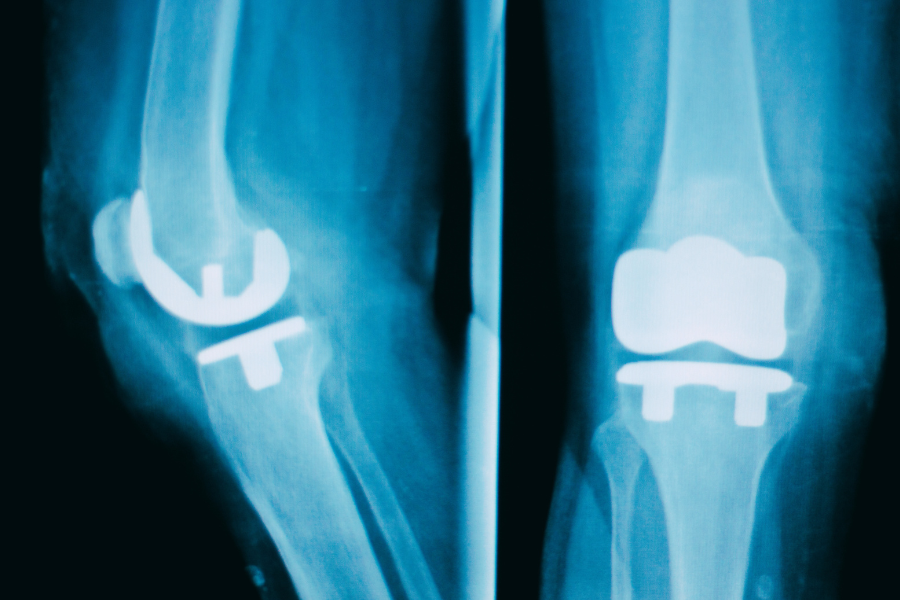 Robotic Knee Replacements