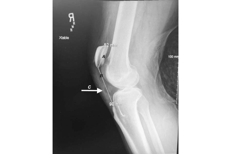 Rupture Of Patellar Tendons