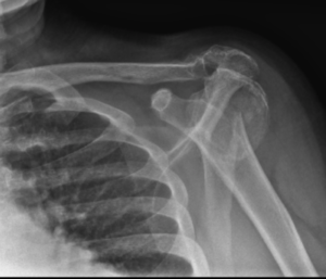 REVERSE TOTAL SHOULDER ARTHROPLASTY