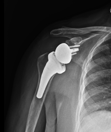 REVERSE TOTAL SHOULDER ARTHROPLASTY