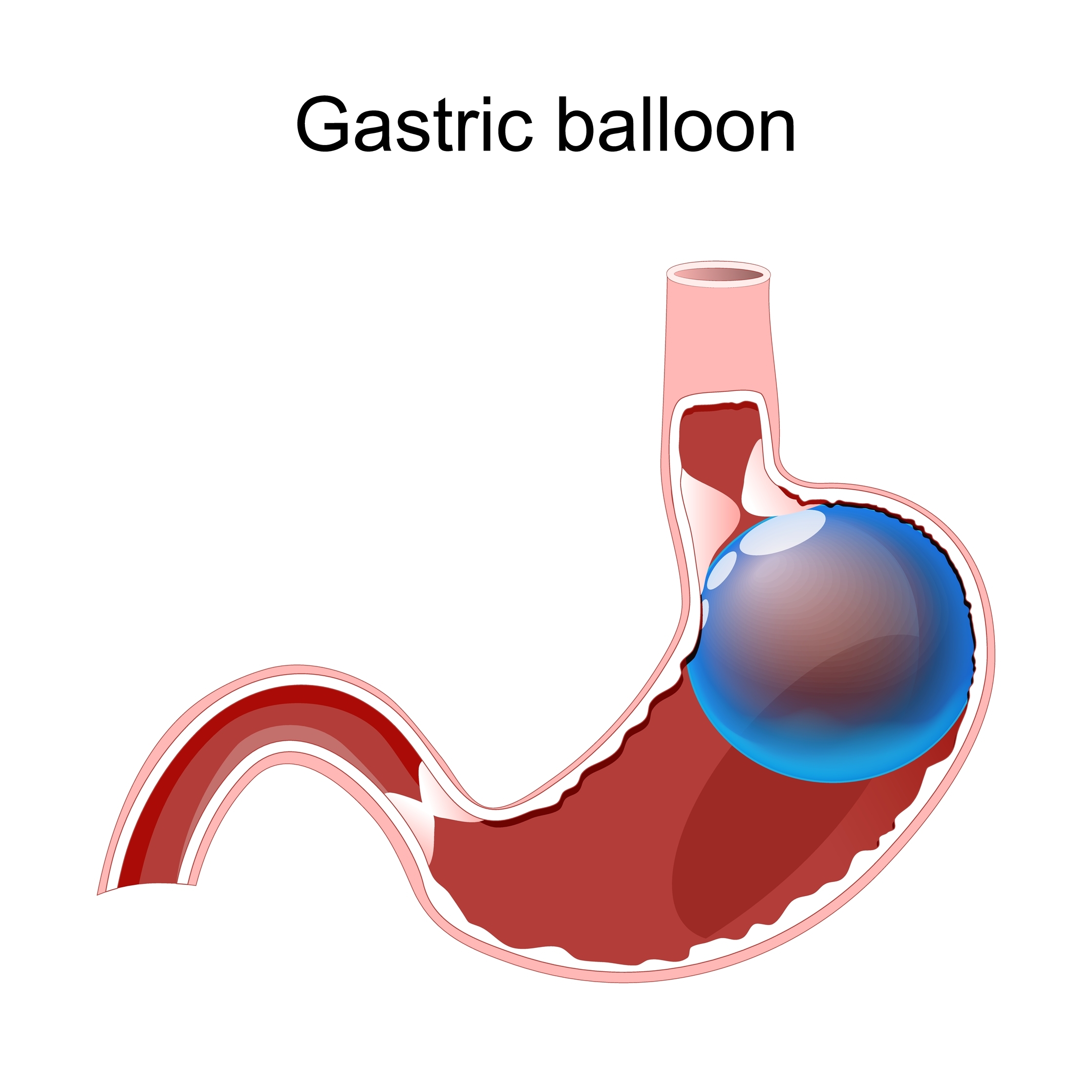 Gastric Balloon