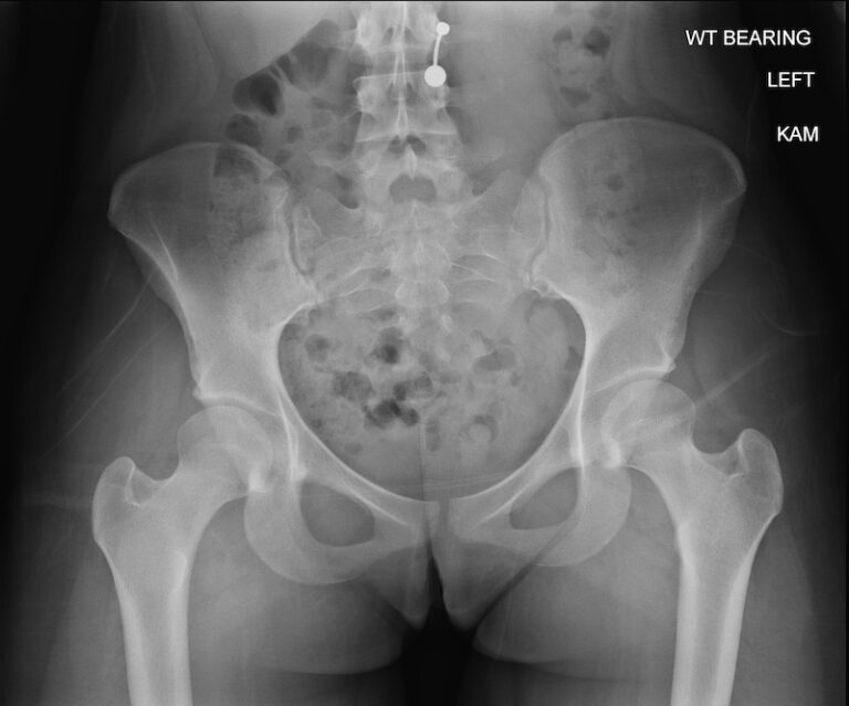 Picture of Addressing Hip Dysplasia: How PAO Can Alleviate Pain