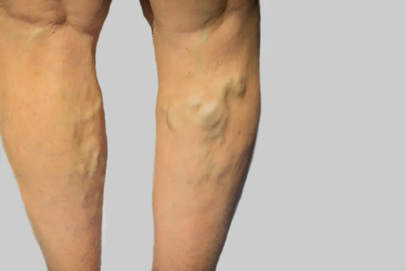 Veiny legs