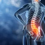 Illustration of the lower spine showing inflammation and nerve-related back pain.